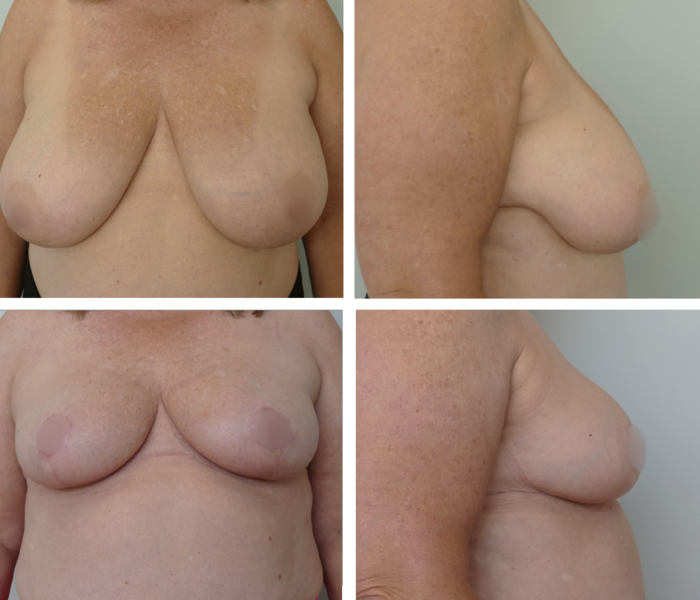 Breast reduction before and after